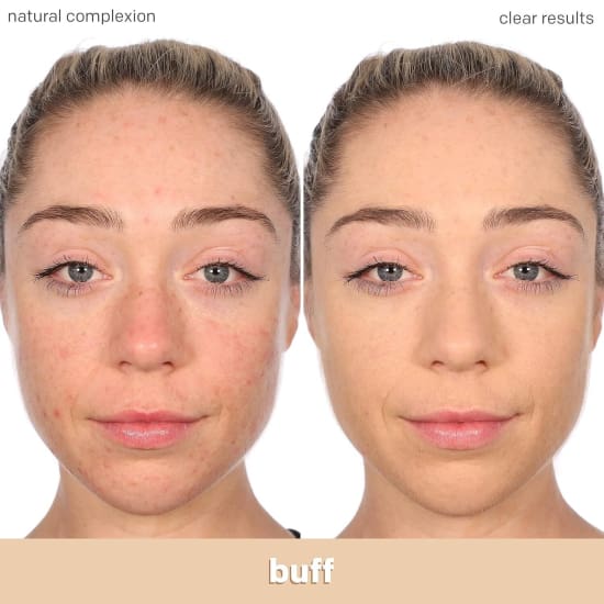 ALMAY Clear Complexion Foundation BUFF 200 30mL salicylic acid acne treatment - Health & Beauty:Makeup:Face:Foundation